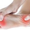 Tratamiento fascial de la fascitis plantar