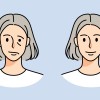 Parálisis facial