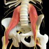 Contractura del Psoas ilíaco